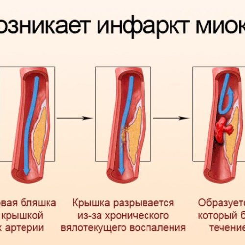 Когда счет идет на минуты: как распознать инфаркт и инсульт